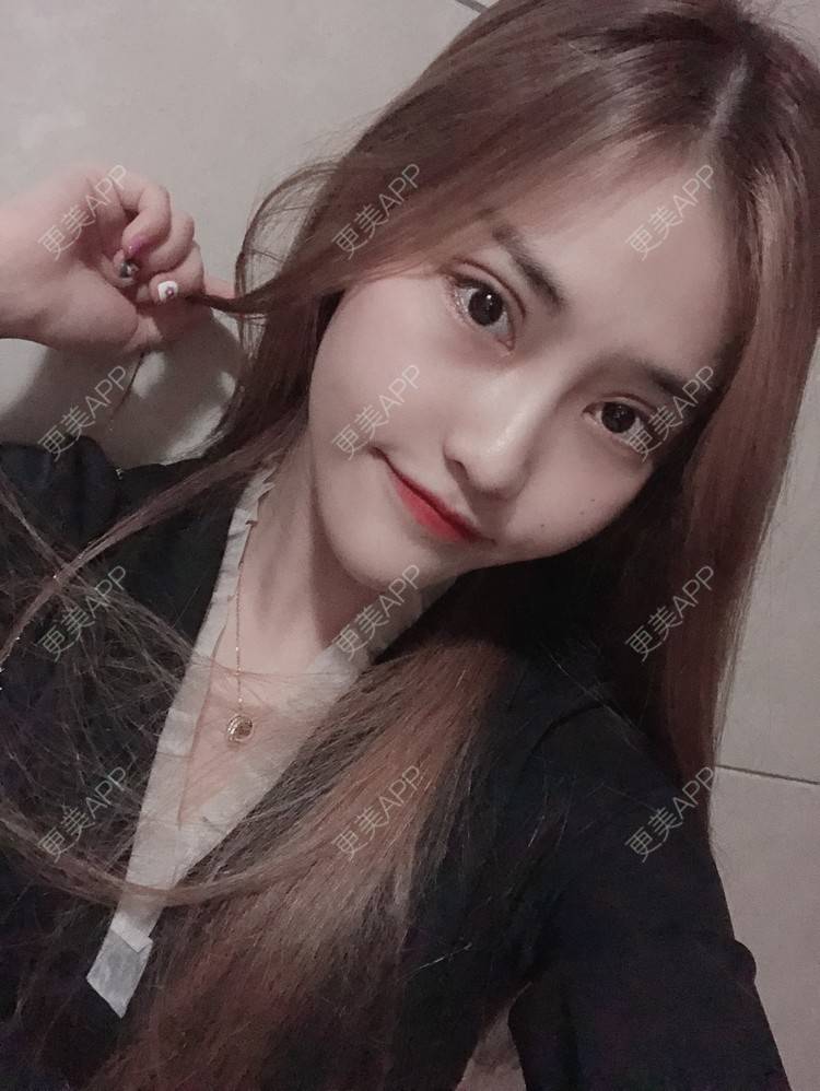 更美 - 小小丽莉的全切双眼皮经验 | 深圳 | 全切双眼皮