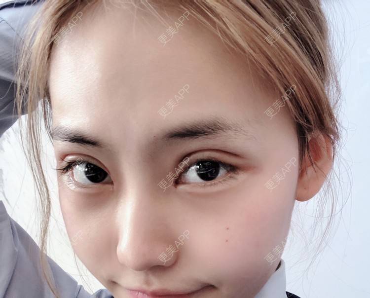 更美 - 小小丽莉的全切双眼皮经验 | 深圳 | 全切双眼皮
