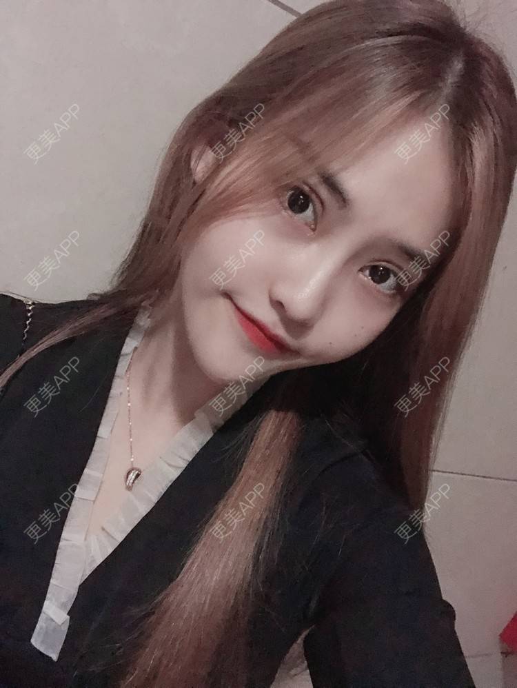 更美 - 小小丽莉的全切双眼皮经验 | 深圳 | 全切双眼皮