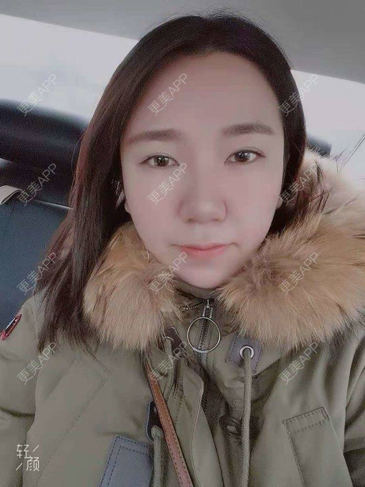 更美 - 更美用户DTbqKu0gAz的光纤瘦脸经验 | 北京 | 光纤溶脂 | 光纤瘦脸