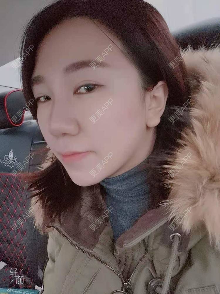 更美 - 更美用户DTbqKu0gAz的光纤瘦脸经验 | 北京 | 光纤溶脂 | 光纤瘦脸