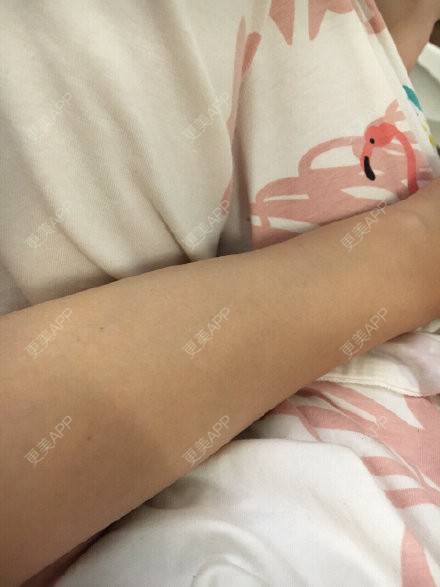 更美 - 夏天的狐狸的激光脱毛经验 | 激光脱毛 | 南昌