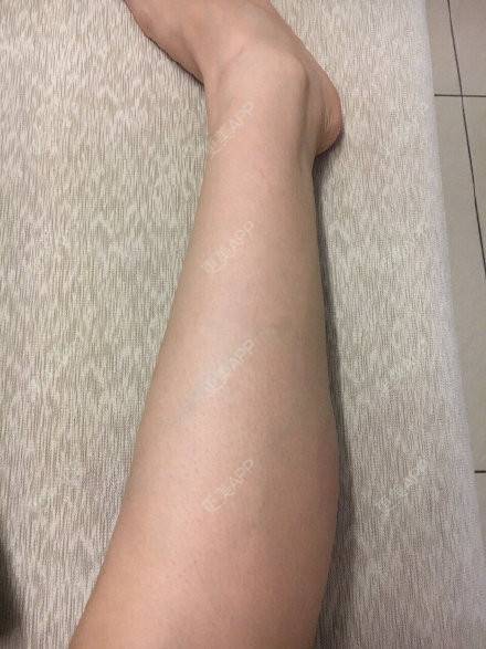 更美 - 夏天的狐狸的激光脱毛经验 | 激光脱毛 | 南昌
