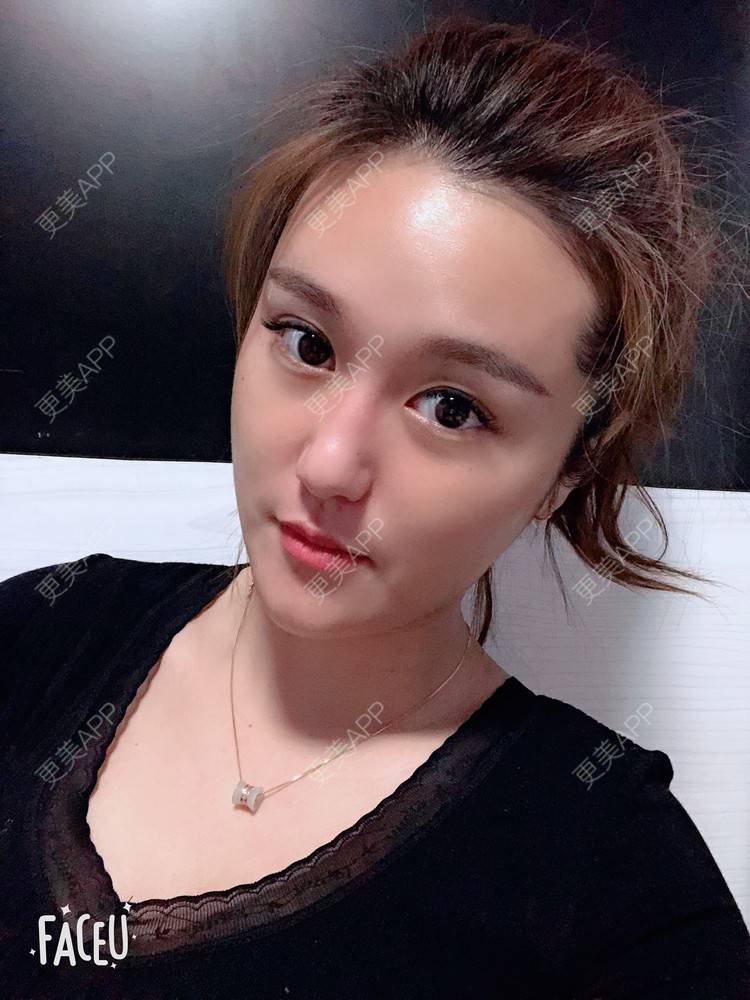 更美 - 更美用户3UXoCNtWel的光纤溶脂经验 | 北京 | 光纤溶脂