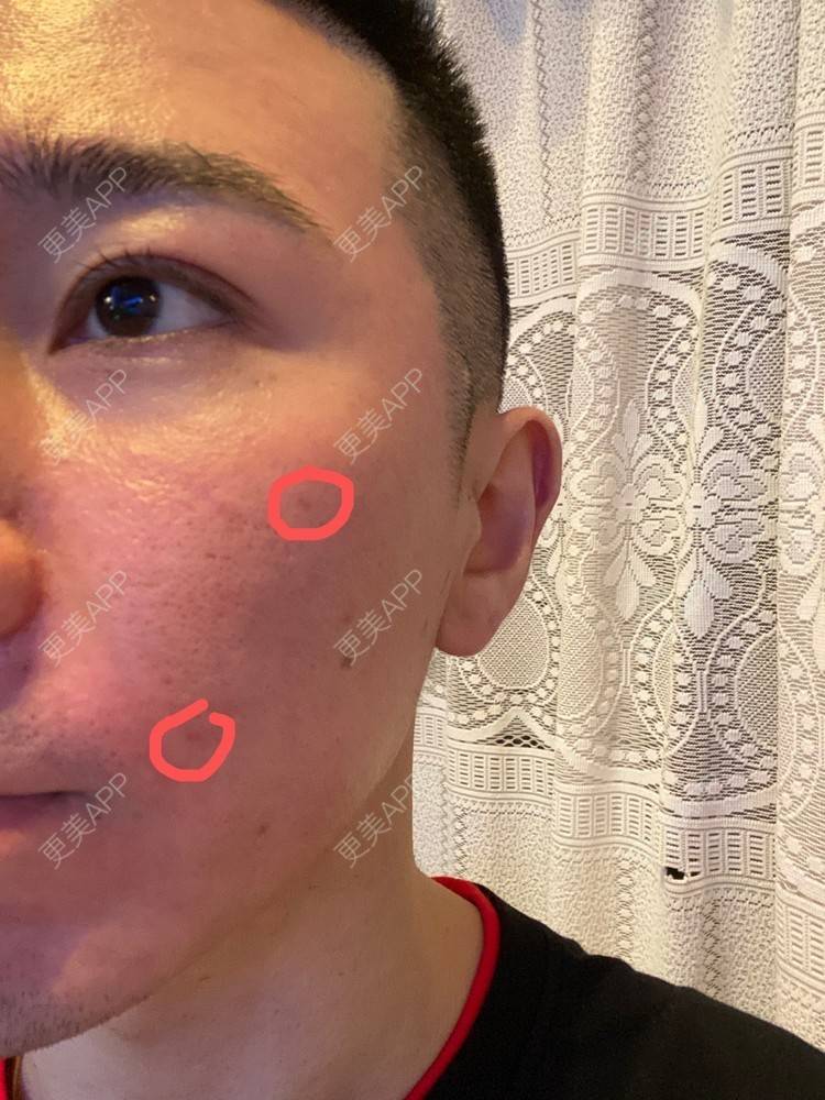 更美 - Es小喵的埋线提升经验 | 广州 | 埋线提升 | 埋线除皱 | V脸套餐