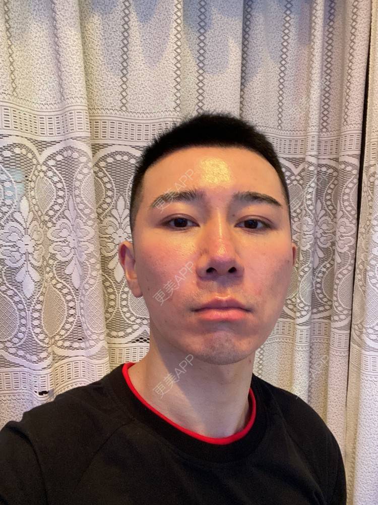 更美 - Es小喵的埋线提升经验 | 广州 | 埋线提升 | 埋线除皱 | V脸套餐