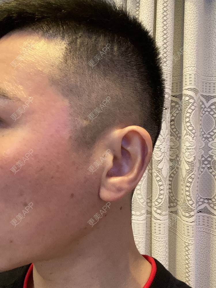 更美 - Es小喵的埋线提升经验 | 广州 | 埋线提升 | 埋线除皱 | V脸套餐