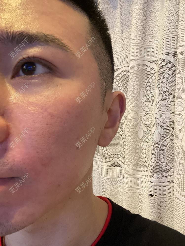 更美 - Es小喵的埋线提升经验 | 广州 | 埋线提升 | 埋线除皱 | V脸套餐