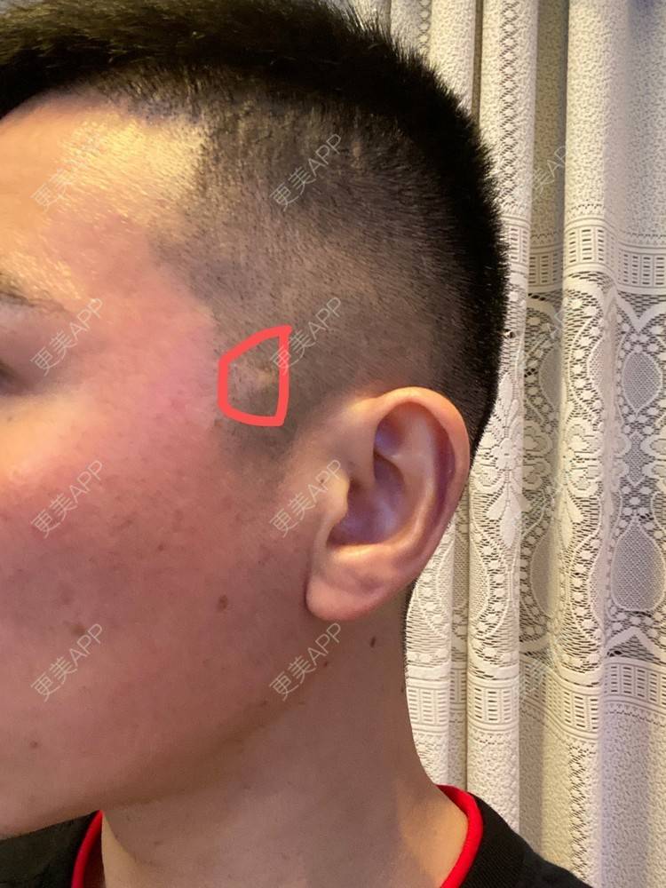 更美 - Es小喵的埋线提升经验 | 广州 | 埋线提升 | 埋线除皱 | V脸套餐