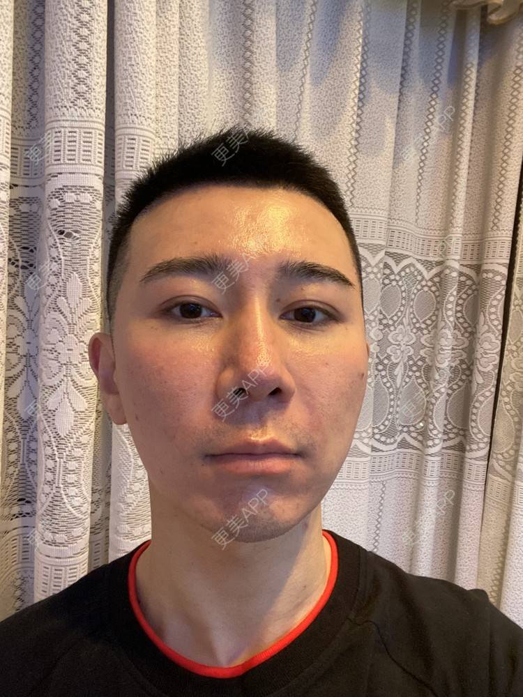 更美 - Es小喵的埋线提升经验 | 广州 | 埋线提升 | 埋线除皱 | V脸套餐