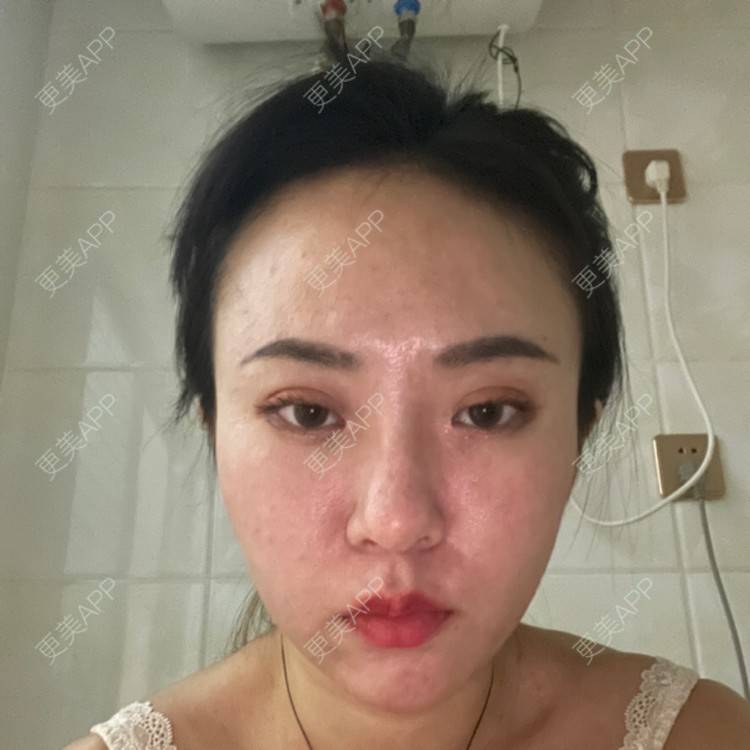 更美 - 樊Bb的微整修复经验 | 玻尿酸下巴 | 玻尿酸额头 | 微整修复 | 玻尿酸太阳穴 | 沈阳 | 玻尿酸
