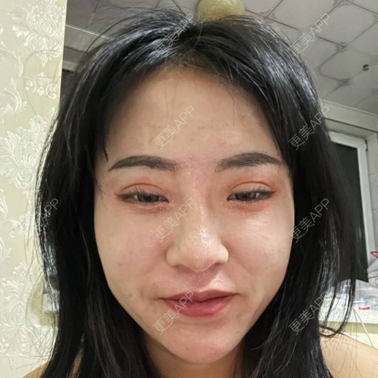 更美 - 樊Bb的微整修复经验 | 玻尿酸下巴 | 玻尿酸额头 | 微整修复 | 玻尿酸太阳穴 | 沈阳 | 玻尿酸