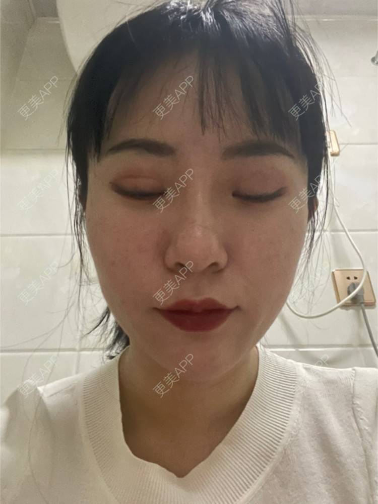 更美 - 樊Bb的微整修复经验 | 玻尿酸下巴 | 玻尿酸额头 | 微整修复 | 玻尿酸太阳穴 | 沈阳 | 玻尿酸