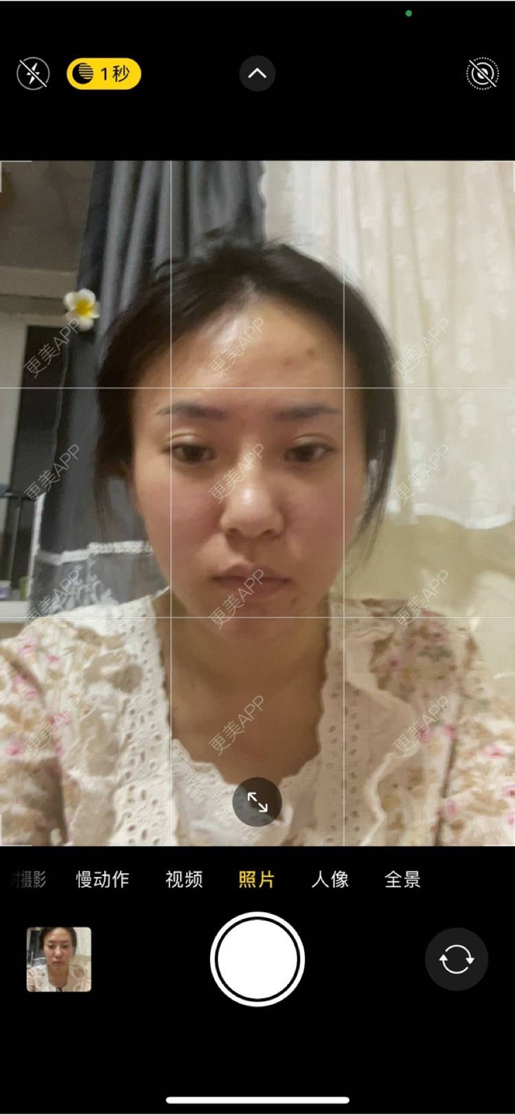 更美 - 樊Bb的微整修复经验 | 玻尿酸下巴 | 玻尿酸额头 | 微整修复 | 玻尿酸太阳穴 | 沈阳 | 玻尿酸