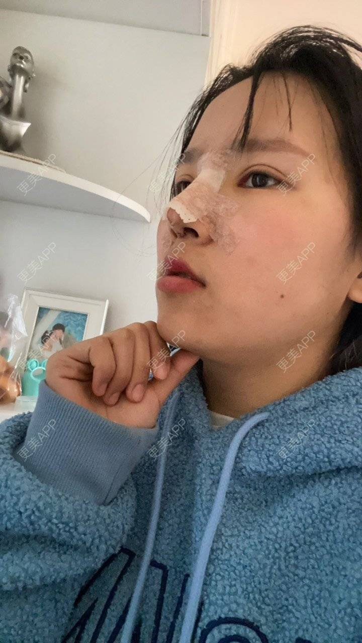 更美 - QHY 💓的鼻部多项经验 | 鼻部多项 | 手术缩鼻头 | 鼻翼缩小 | 郑州 | 耳软骨隆鼻