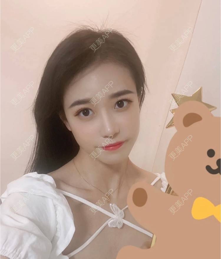 更美 - 更美用户jIHznB4J6a的玻尿酸苹果肌经验 | 杭州 | 玻尿酸苹果肌 | 玻尿酸全面部