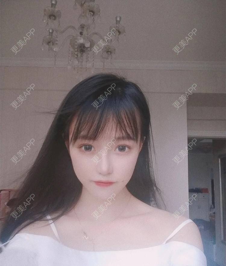 更美 - 更美用户jIHznB4J6a的玻尿酸苹果肌经验 | 杭州 | 玻尿酸苹果肌 | 玻尿酸全面部