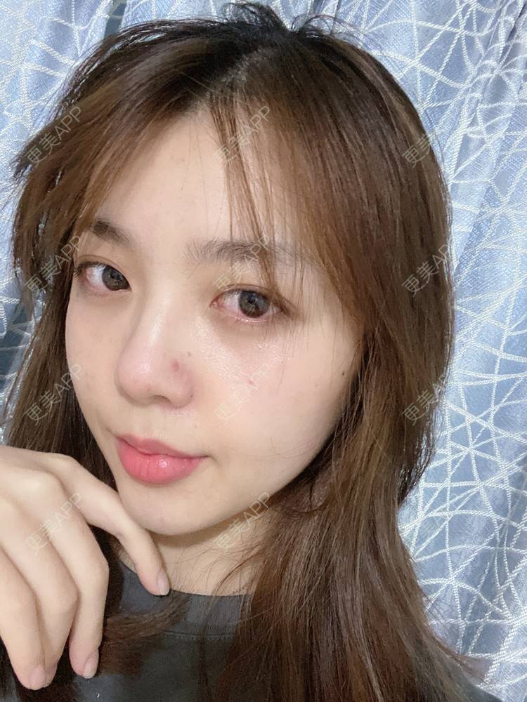 更美 - 周萱萱周周的小切口手术提升经验 | 北京 | 小切口手术提升