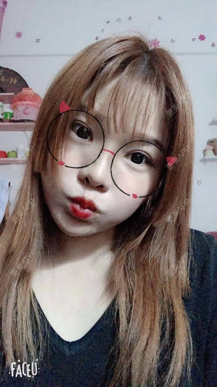更美 - 小小小迷妹的吸脂瘦脸经验 | 吸脂瘦脸 | 双下巴吸脂 | 深圳