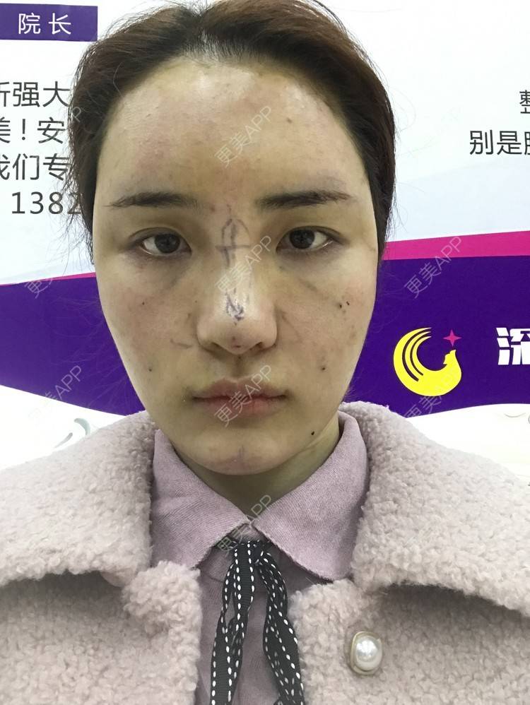 更美 - •你的小可爱•的自体脂肪垫下巴经验 | 玻尿酸溶解酶 | 自体脂肪垫鼻基底 | 自体脂肪丰太阳穴 | 自体脂肪垫下巴 | 深圳