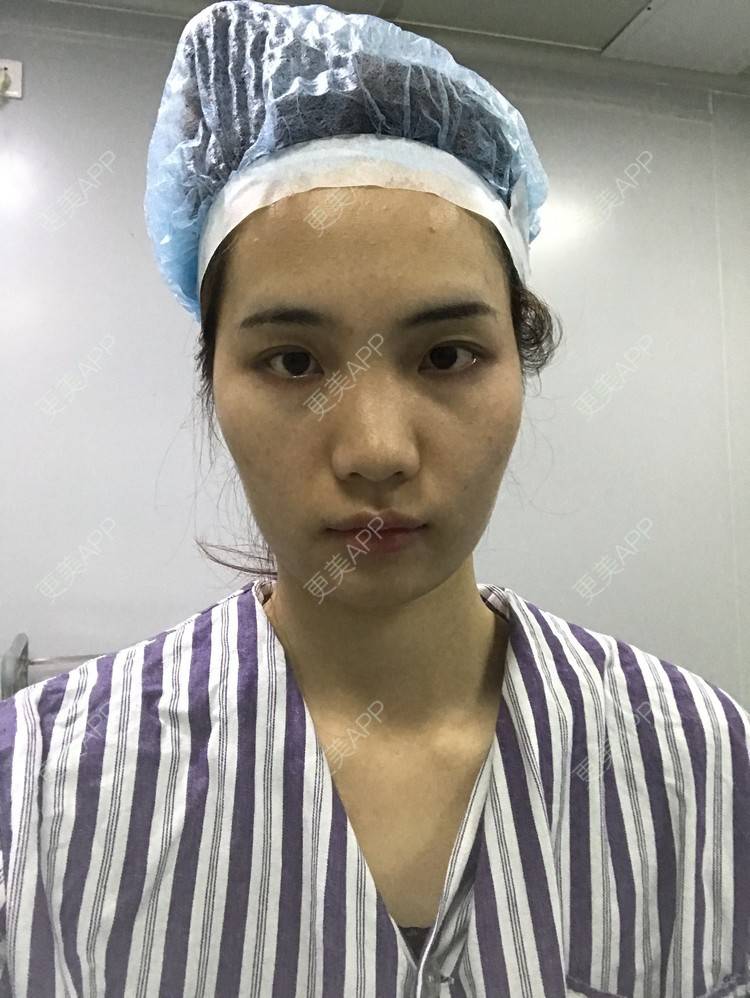 更美 - •你的小可爱•的自体脂肪垫下巴经验 | 玻尿酸溶解酶 | 自体脂肪垫鼻基底 | 自体脂肪丰太阳穴 | 自体脂肪垫下巴 | 深圳