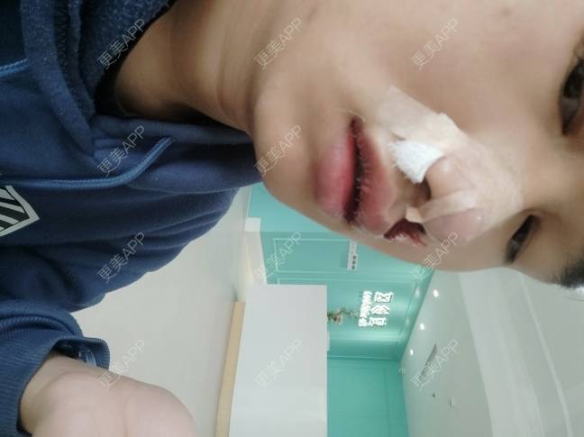 更美 - 更美用户Dc0uLvMdeZ的手术缩鼻头经验 | 手术缩鼻头 | 鼻翼缩小 | 佛山