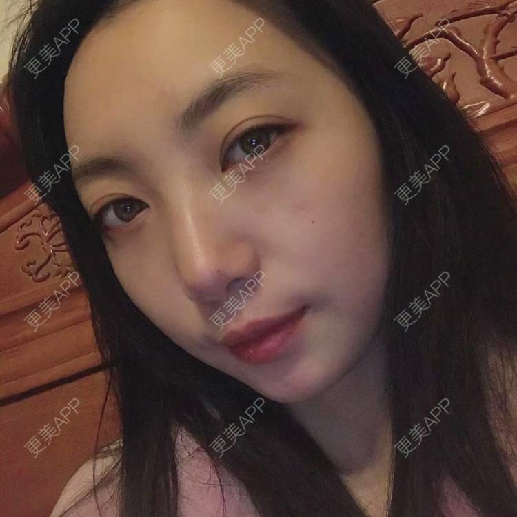 更美 - 凤求凰于飞的祛眼袋经验 | 内切去眼袋 | 外切去眼袋 | 眶隔脂肪释放 | 激光去眼袋 | 射频去眼袋 | 祛眼袋 | 吸脂去眼袋