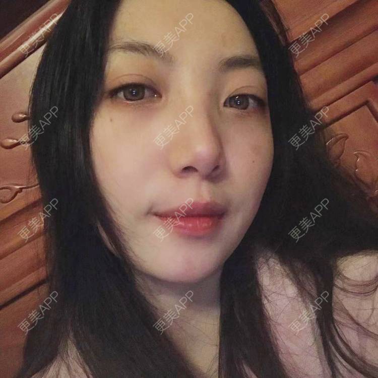 更美 - 凤求凰于飞的祛眼袋经验 | 内切去眼袋 | 外切去眼袋 | 眶隔脂肪释放 | 激光去眼袋 | 射频去眼袋 | 祛眼袋 | 吸脂去眼袋