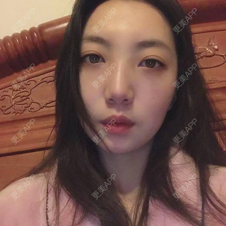 更美 - 凤求凰于飞的祛眼袋经验 | 内切去眼袋 | 外切去眼袋 | 眶隔脂肪释放 | 激光去眼袋 | 射频去眼袋 | 祛眼袋 | 吸脂去眼袋