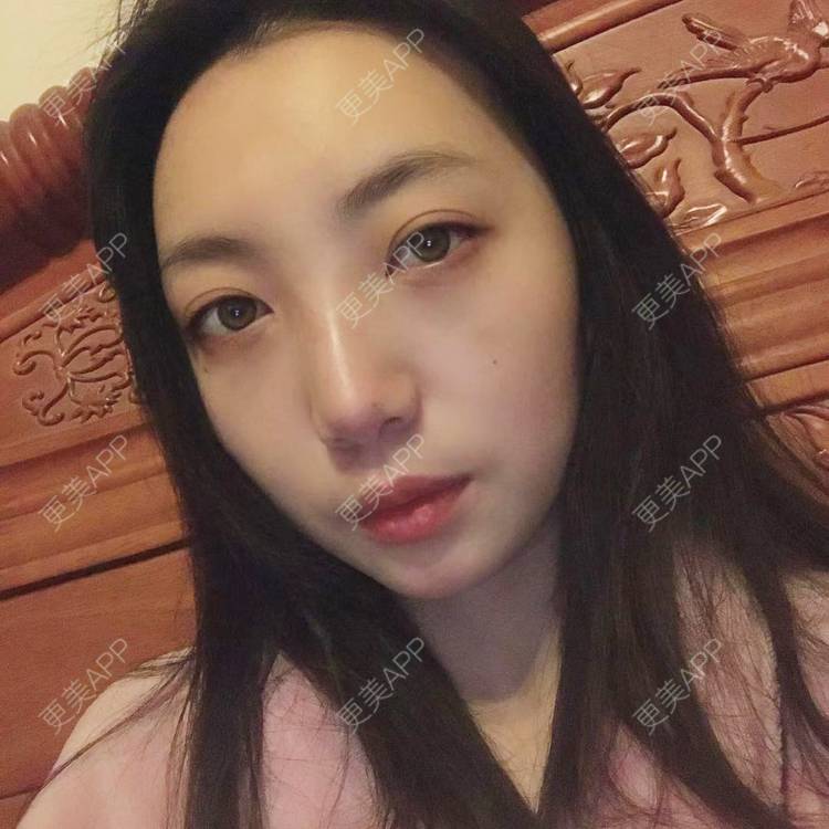 更美 - 凤求凰于飞的祛眼袋经验 | 内切去眼袋 | 外切去眼袋 | 眶隔脂肪释放 | 激光去眼袋 | 射频去眼袋 | 祛眼袋 | 吸脂去眼袋