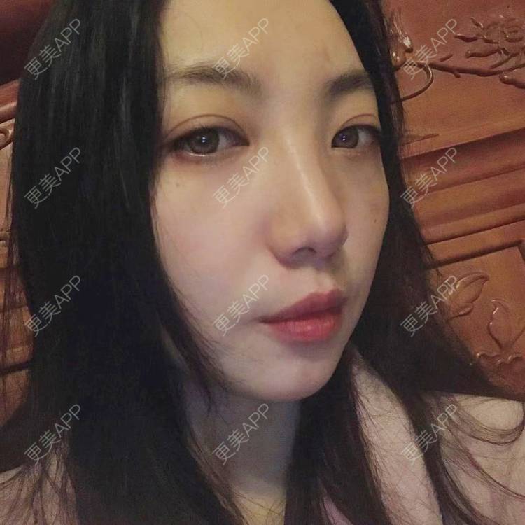 更美 - 凤求凰于飞的祛眼袋经验 | 内切去眼袋 | 外切去眼袋 | 眶隔脂肪释放 | 激光去眼袋 | 射频去眼袋 | 祛眼袋 | 吸脂去眼袋