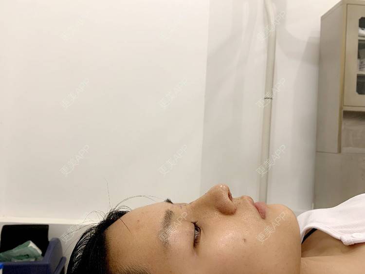 更美 - 肉嘟嘟儿的鼻部多项经验 | 杭州 | 鼻部多项