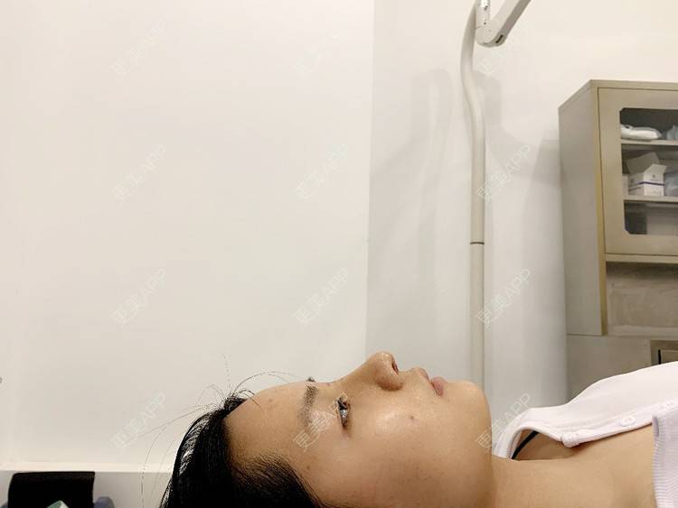 更美 - 肉嘟嘟儿的鼻部多项经验 | 杭州 | 鼻部多项