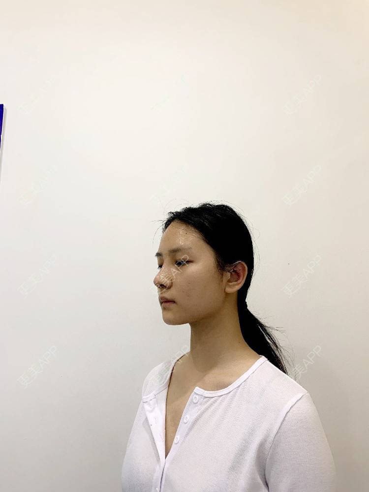更美 - 肉嘟嘟儿的鼻部多项经验 | 杭州 | 鼻部多项