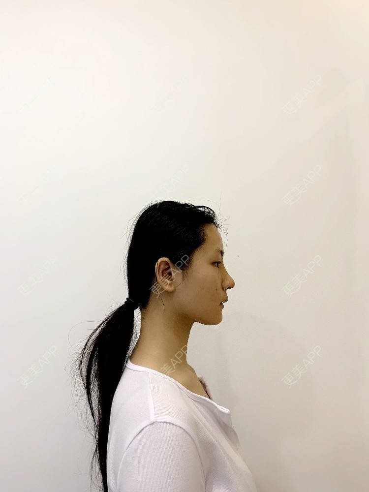 更美 - 肉嘟嘟儿的鼻部多项经验 | 杭州 | 鼻部多项