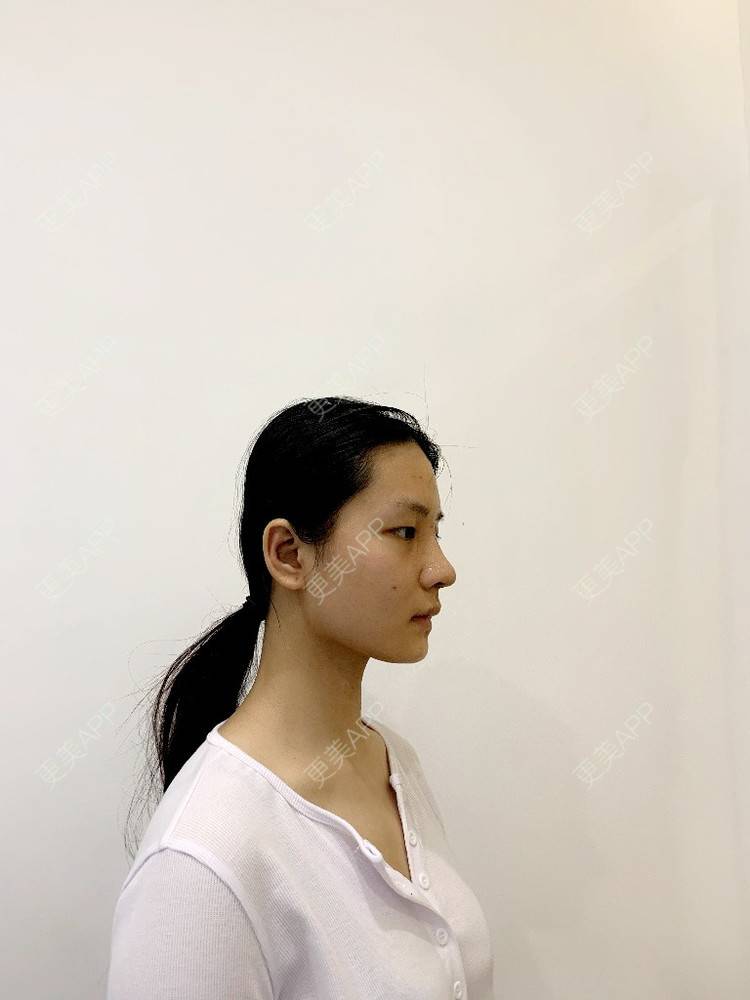 更美 - 肉嘟嘟儿的鼻部多项经验 | 杭州 | 鼻部多项