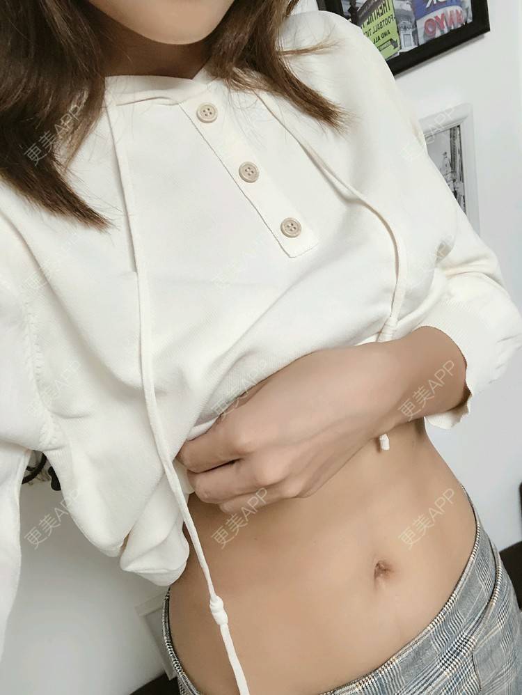更美 - 更美用户ScoEdVXjYv的冷冻减脂瘦腹部经验 | 冷冻减脂瘦腹部 | 冷冻减脂瘦腹部