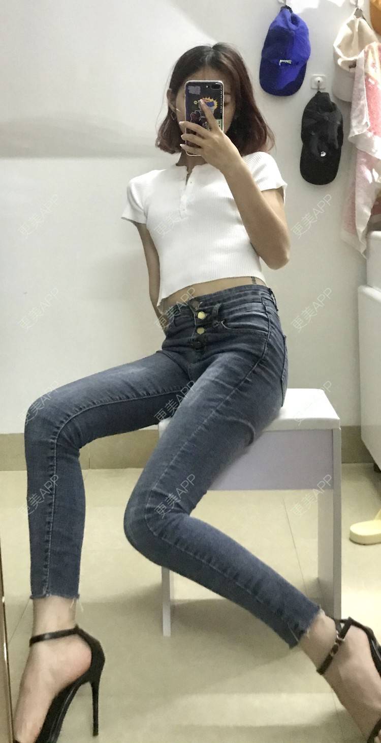 更美 - WHSHHB的腹部吸脂经验 | 腹部吸脂 | 杭州 | 腰部吸脂