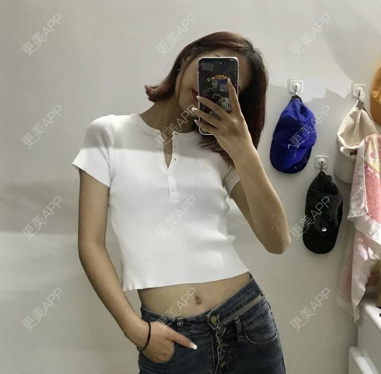 更美 - WHSHHB的腹部吸脂经验 | 腹部吸脂 | 杭州 | 腰部吸脂