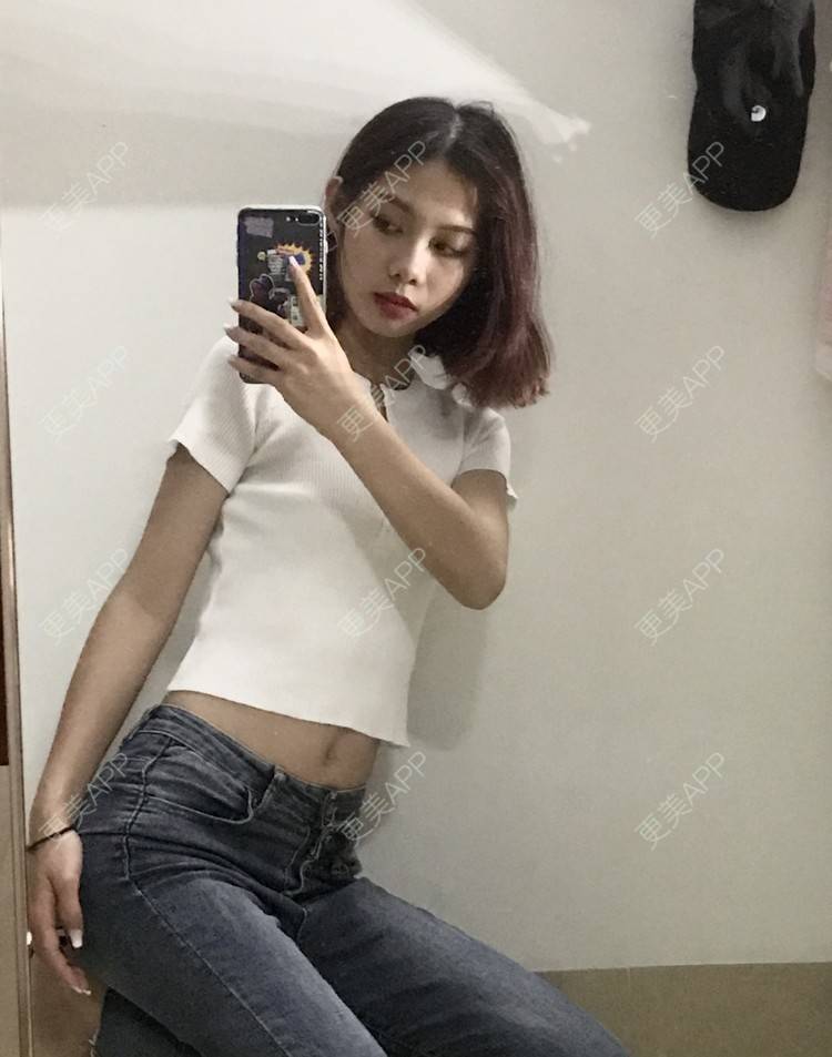 更美 - WHSHHB的腹部吸脂经验 | 腹部吸脂 | 杭州 | 腰部吸脂