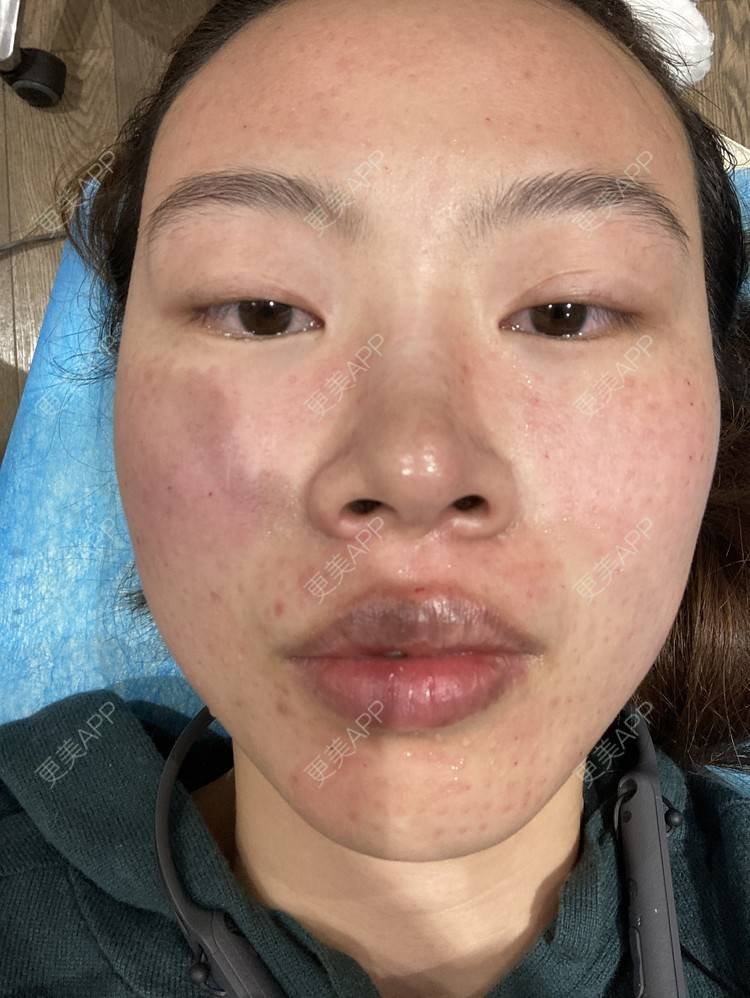 更美 - 更美用户CCLYSpsRdQ的水光项目经验 | 水光项目 | 上海 | 补水套餐