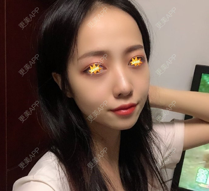 更美 - 幸福の成若游的自体脂肪全面部填充经验 | 自体脂肪全面部填充 | 广州