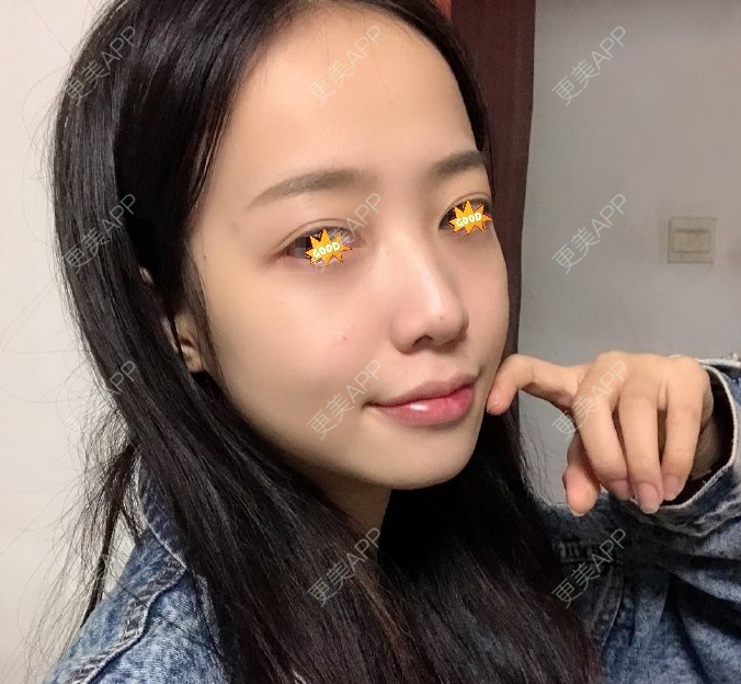 更美 - 幸福の成若游的自体脂肪全面部填充经验 | 自体脂肪全面部填充 | 广州