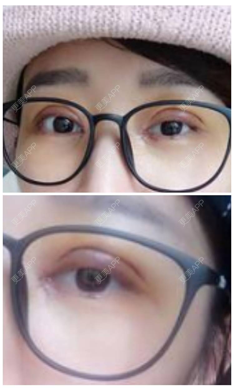 更美 - 总被自己萌到凹的全切双眼皮经验 | 全切双眼皮 | 广州