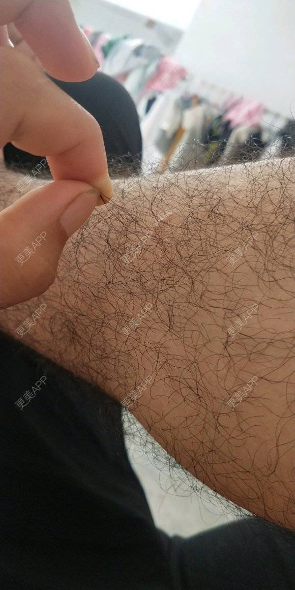 更美 - 福果果的激光脱毛经验 | 激光脱毛 | 南昌