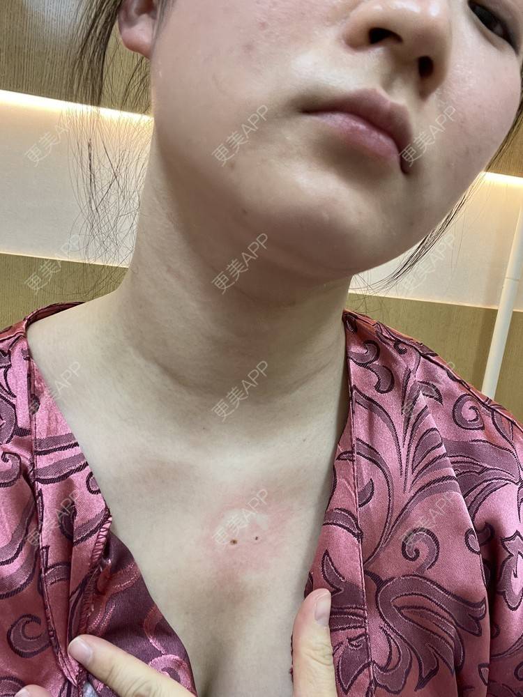 更美 - ☞小燕儿的改善动态纹经验 | 改善动态纹 | 北京