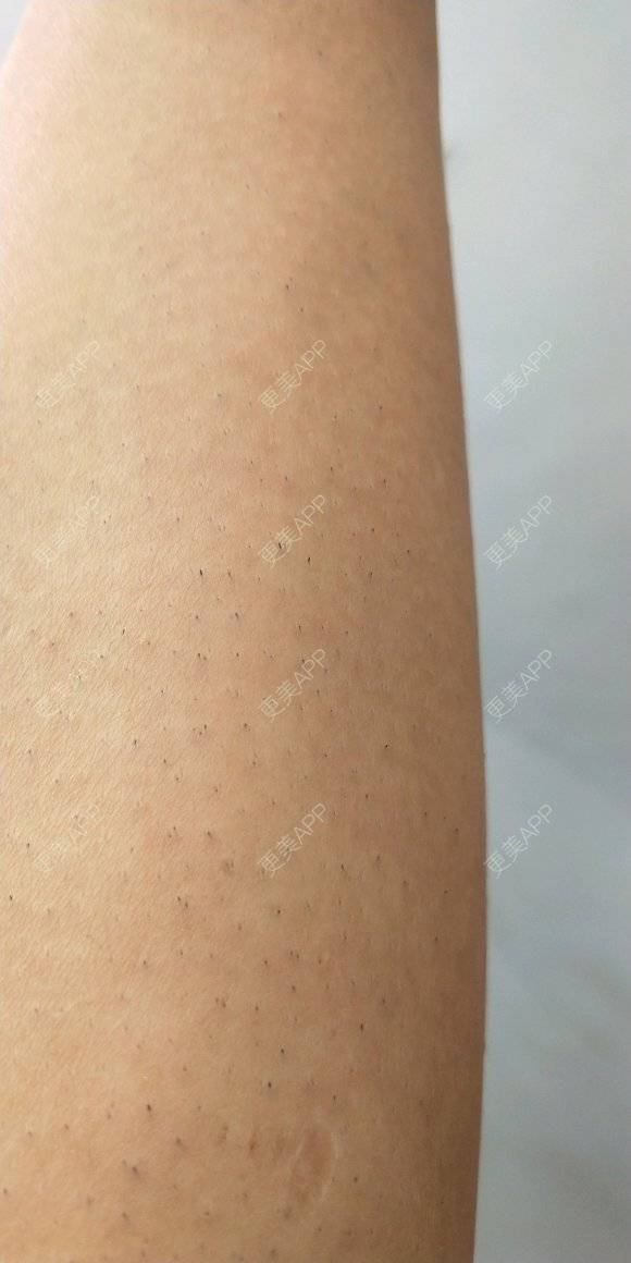 更美 - 福果果的激光脱毛经验 | 激光脱毛 | 南昌