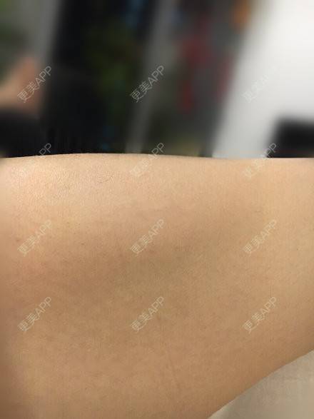 更美 - 福果果的激光脱毛经验 | 激光脱毛 | 南昌