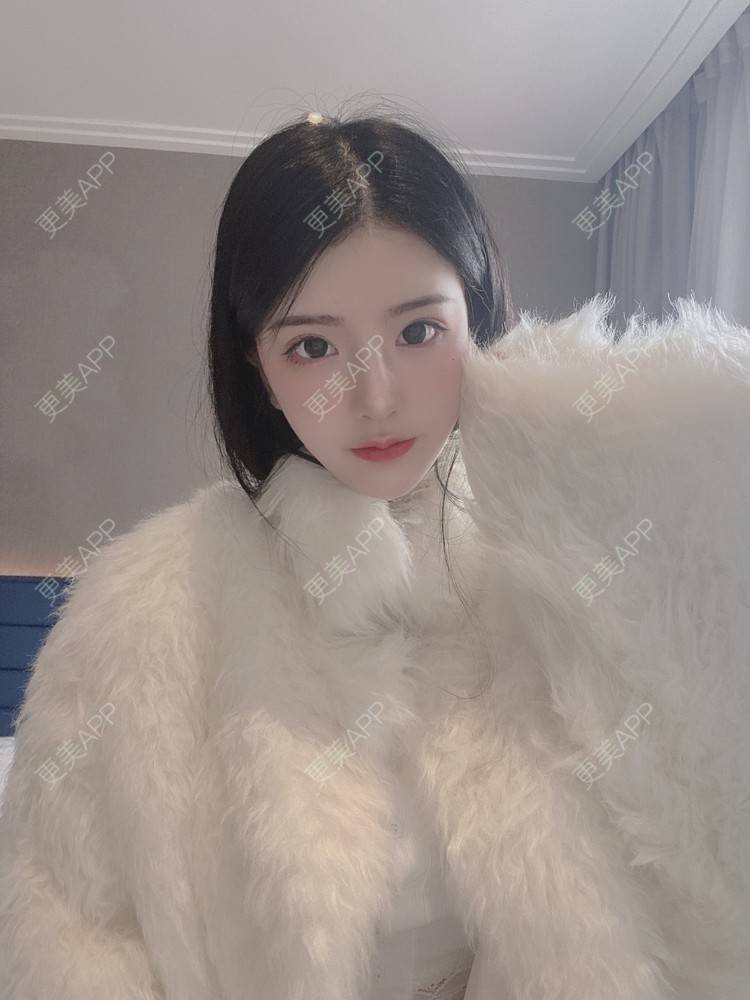 更美 - 更美用户aILgbrC9lH的颧弓降低经验 | 郑州 | 颧弓降低