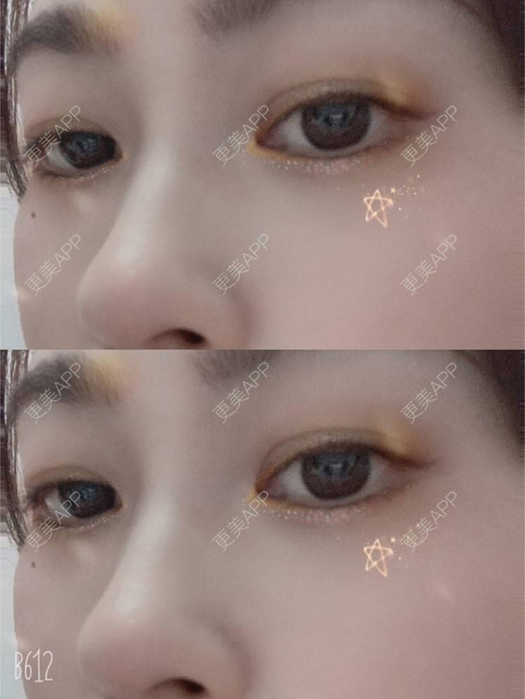 更美 - 哎呀妈呀哟的光子嫩肤经验 | 光子嫩肤 | 上海